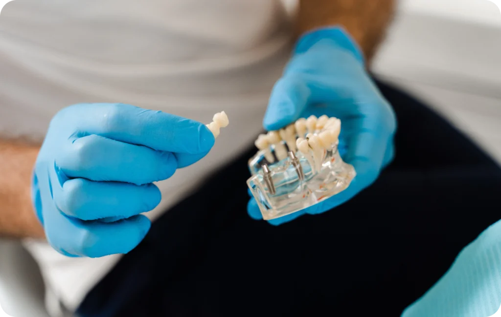 bridge implant pose implant dentaire chirurgie orale