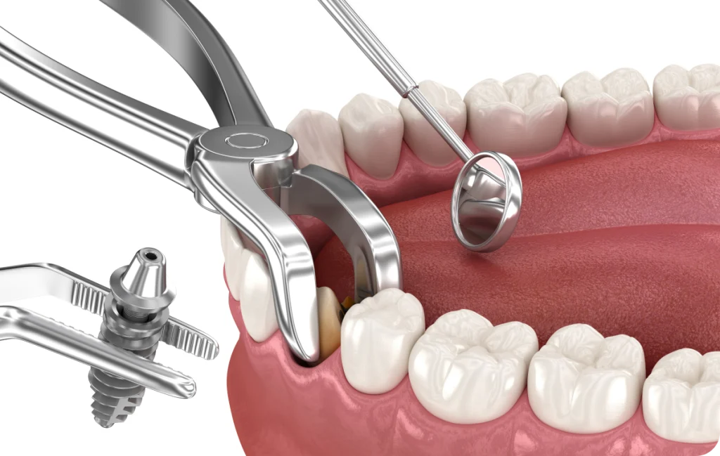 extraction dent ectopique corbeil essonnes