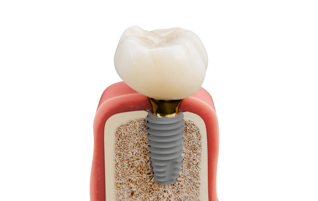 extraction dent ectopique incluse