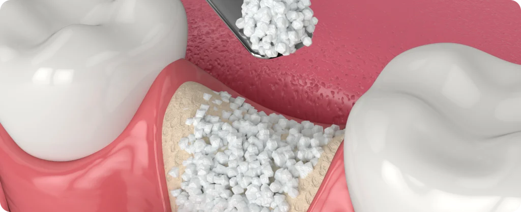 greffe osseuse preparation implant