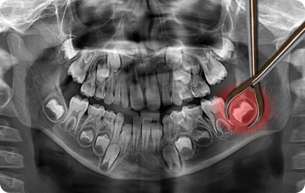 dents sagesse douleur inflammation