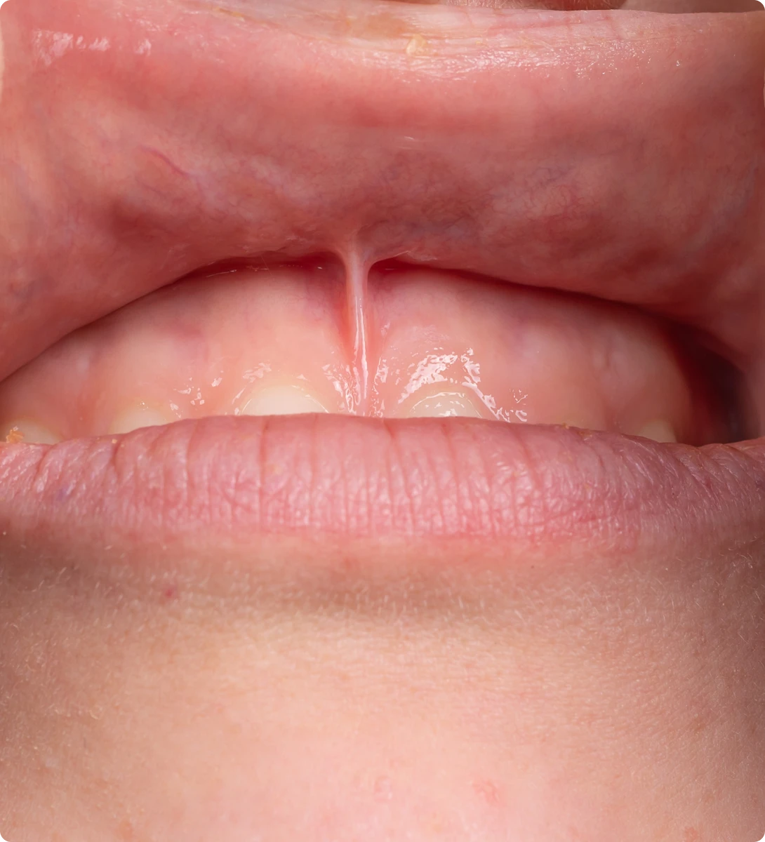 frenectomie dentiste kaufmann