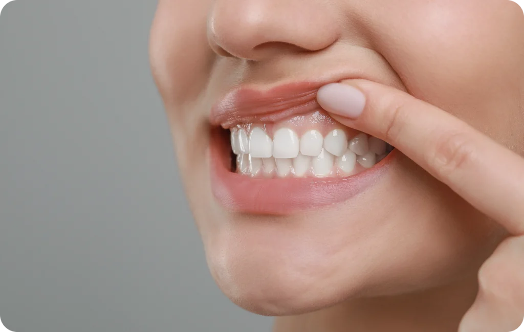 greffe gingivale sante gingivale