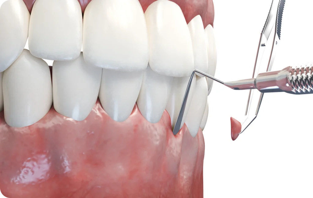 greffe gingivale sante parodontale