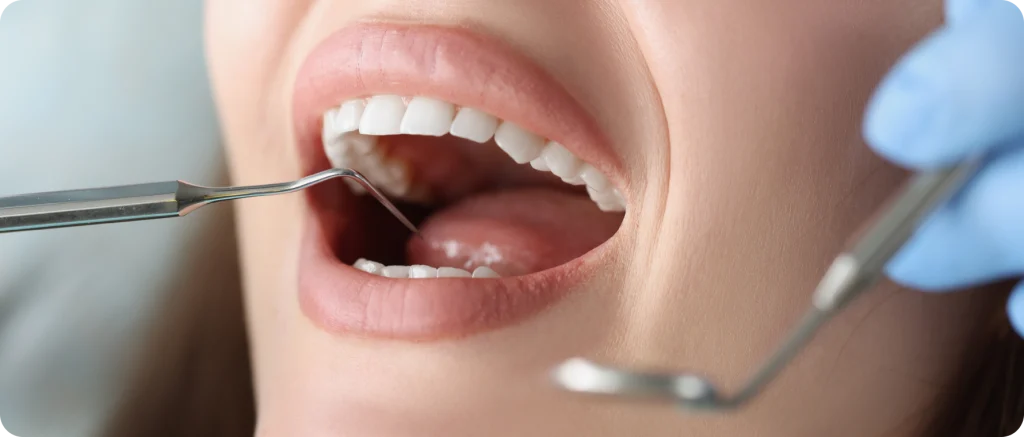 greffe gingivale stabilite dentaire