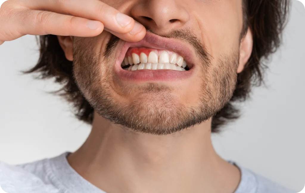 resection apicale chirurgie racinaire