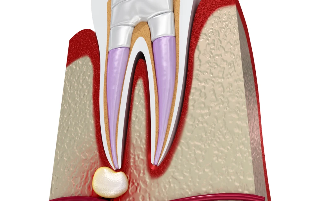 resection apicale soins avances